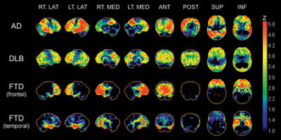FTD Research Dementia Brain Scan